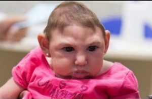 طفل مصاب بفايرس زيكا